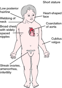 turner_syndrome_symptom_diagram